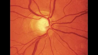 Optic nerve head changes in Glaucoma