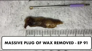 MASSIVE PLUG OF EAR WAX REMOVED - EP 91