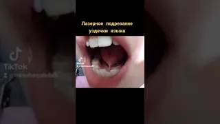 Лазерное подрезание уздечки языка