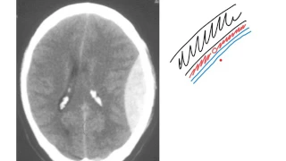 Extradural haemorrhage