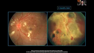 Retina Connect Webinar: Managing proliferative diabetic retinopathy