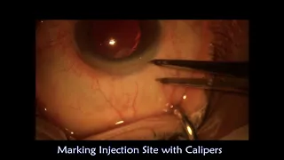 Intravitreal Anti-VEGF Injections