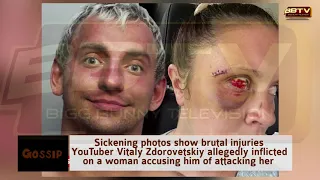 YOUTUBE STAR VITALYALLEGED VICTIM'S BRUTAL INJURY PHOTOS ...Assault Lawsuit Filed