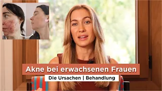 Spätakne: Der ultimative Leitfaden für eine dauerhaft, reine Haut für Frauen | 20+ Tipps