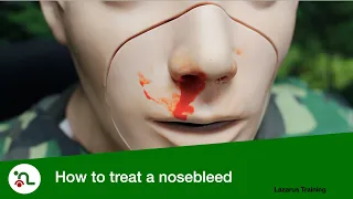 How to treat a Nosebleed