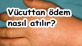 Vücuttan ödem nasıl atılır