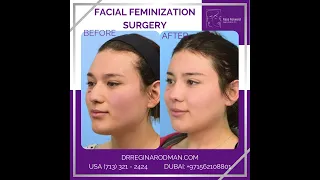 Facial Feminization Surgery | FFS with Dr. Regina Rodman in Houston, TX