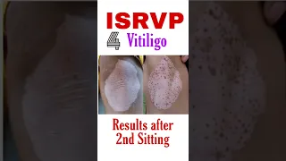 New Treatment for Vitiligo | Leucoderma cure