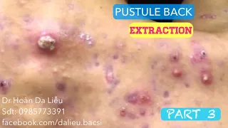 Mụn trứng cá mủ lưng cực nặng|Dermatologist,pimples,whitehead,acne conglobata pustule extraction 3