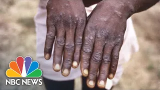 What You Need To Know About The Monkeypox Virus