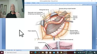 Hernia in Arabic 13 ( Indirect Inguinal hernia , part 4 ) , by Dr. Wahdan .