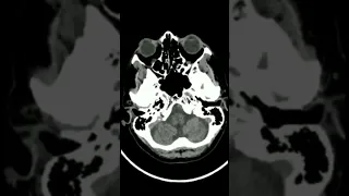 Blow Out Fracture left Orbit