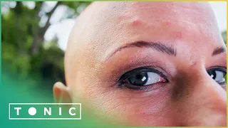 Is It Possible To Improve Alopecia With Food? | The Food Hospital
