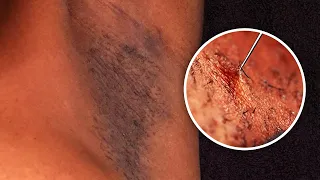 How To Get Rid Of Dark Spots On Armpits - Ingrown Hair Treatment