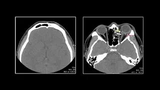 Neuro Trauma III | Interesting Radiology Cases