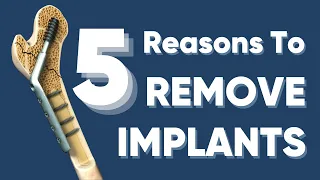 फ्रैक्चर ठीक होने के बाद क्या प्लेट/स्क्रू/रोड निकलना ज़रूरी है ?implant removal after fracture heals