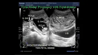 Twin molar pregnancy with Fetal demise.