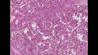 Histopathology Kidney--Acute and chronic pyelonephritis