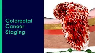 Colorectal Cancer Staging