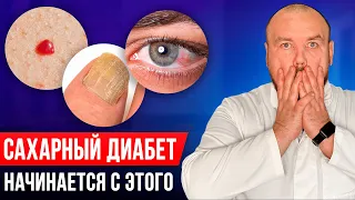 Первые признаки САХАРНОГО ДИАБЕТА 2 ТИПА! Проверь это пока не поздно...