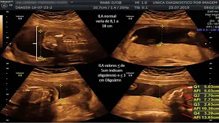 Oligoâmnio ou Diminuição de líquido na cavidade amniótica