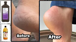 AMAZING-Try Hydrogen Peroxide & Vinegar on Dry Heels/ Toe Fungus/ Athlete's Foot