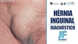 HÉRNIAS ABDOMINAIS (Parte 7): INGUINAL E FEMORAL (DIAGNÓSTICO) 👨🏽‍⚕️🚑 Joao Fonseca (Cir. Geral)