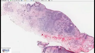 Skin: Basal cell carcinoma Microscopy - Talking slide