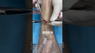 腱鞘囊腫移除 ganglion cyst removal