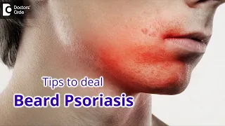 TRY AYURVEDA FOR BEARD PSORIASIS | Tips to manage Beard Psoriasis-Dr.Chaithanya KS | Doctors' Circle
