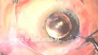 Intracameral antibiotics a must to avoid infection post-cataract surgery