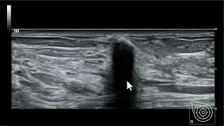 Significado das sombras acústicas intensas na ultrassonografia mamária
