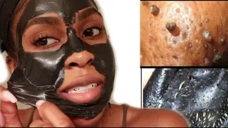 EASY Blackhead and Whitehead Remover Peel Off Mask!