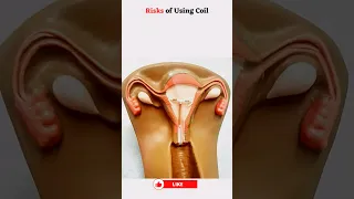 Copper IUD 😲 #shortvideo #share