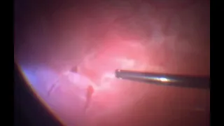 Vitrectomy for Retinal Detachment with Horse shoe tear | Retinal Detachment  | Dr Manish Nagpal