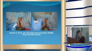 Васильченко И Л - Брахитерапия высокой мощности дозы НDR при местнораспространенном раке предстате