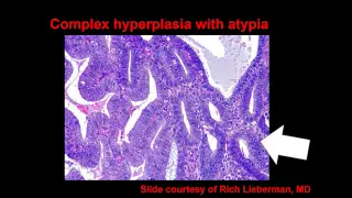 Topic 54: Endometrial Hyperplasia and Carcinoma