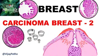 Diseases of Breast: Part 5: Breast carcinoma- DCIS, LCIS & Paget's Disease of Nipple