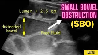 Ultrasound video  Demonstrating Small Bowel Obstruction (SBO)
