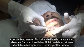 VOLOMED BARTTRANSPLANTATION