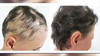 Alopecia: doença inflamatória que causa a queda de cabelo