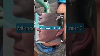 Мікрострум🔥Це магія поза Хогвардсом, переконайтесь в цьому самостійно✨ #мікроструми #косметологльвів