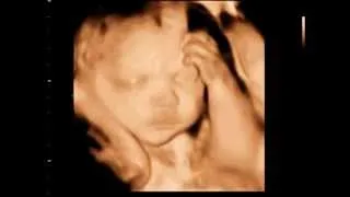 Pregnancy week by week, 31 weeks baby 3D Ultrasound