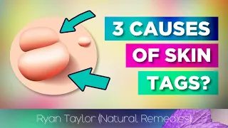 3 Causes Of Skin Tags