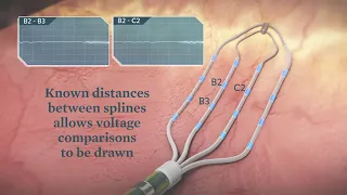 AdvisorHD Grid Mapping Catheter