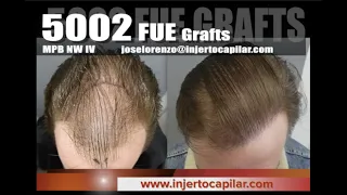 5002 FUE Grafts. MPB NW IV. 2 step strategy. Injertocapilar.com. 1430/2015