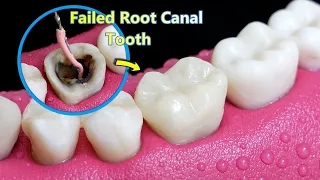 INCREDIBLE Reconstruction Of Poor/Failed Root Canal Treated Tooth.