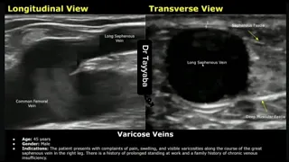 Varicose Vein Doppler Ultrasound Report Example | Lower Limb Venous Insufficiency Sonography USG