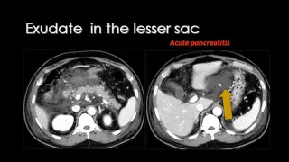 Imaging of the peritoneum   DRE 12   Dr Mamdouh Mahfouz 720p