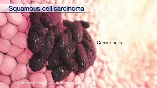 Understanding Head and Neck Cancer